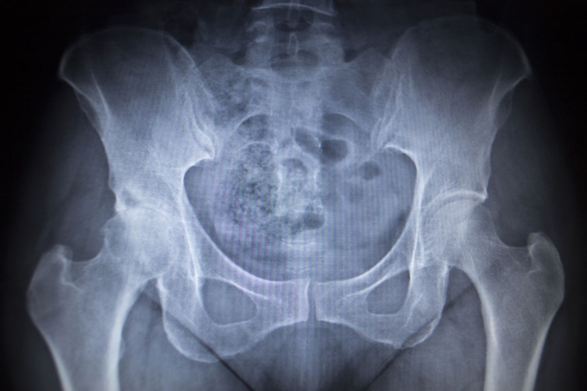 osteoarthritis of the hip