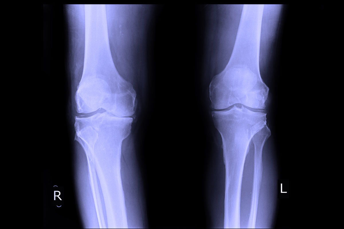 osteoarthritis of the knee