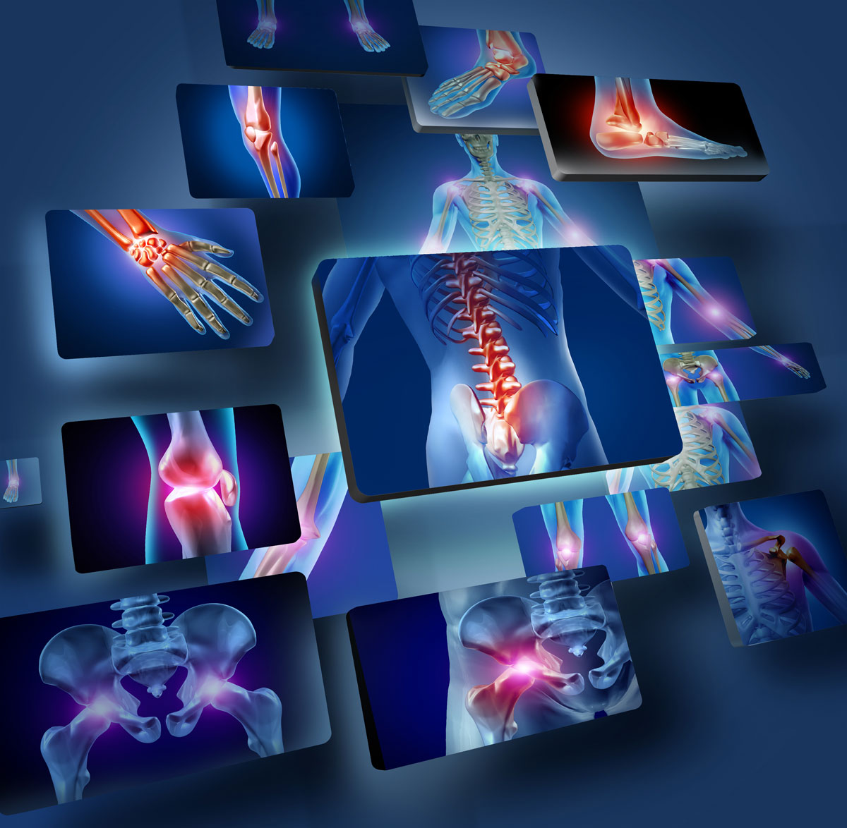 דלקת מפרקים שגרונית - Rheumatoid Arthritis