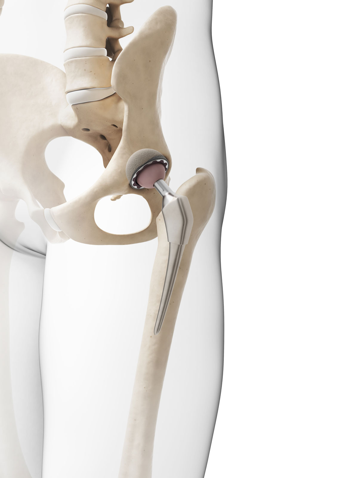 surgical treatment for osteoarthritis
