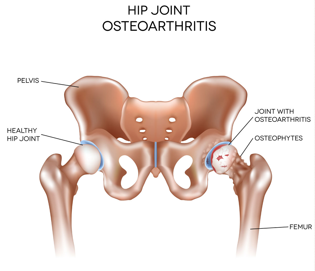 אוסטאוארטריטיס של מפרק הירך